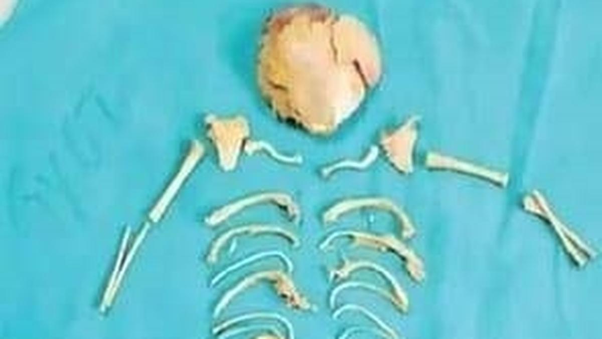 Rare abdominal pregnancy case successfully treated at King George Hospital in Visakhapatnam