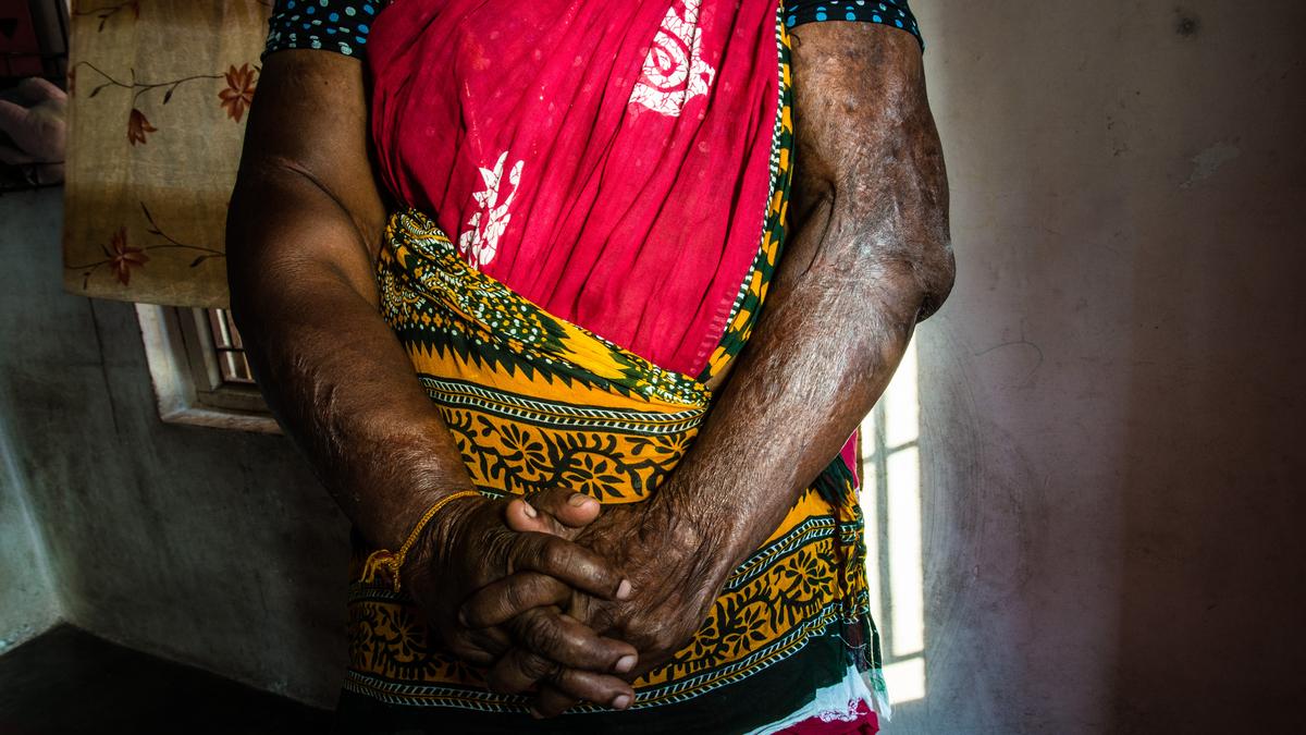 Research suggests mental health support for burn survivors in health facilities to deal with stigma