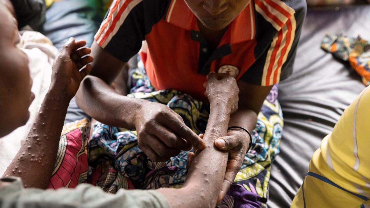 UNICEF issues emergency tender to secure mpox vaccines with Africa CDC, Gavi and WHO