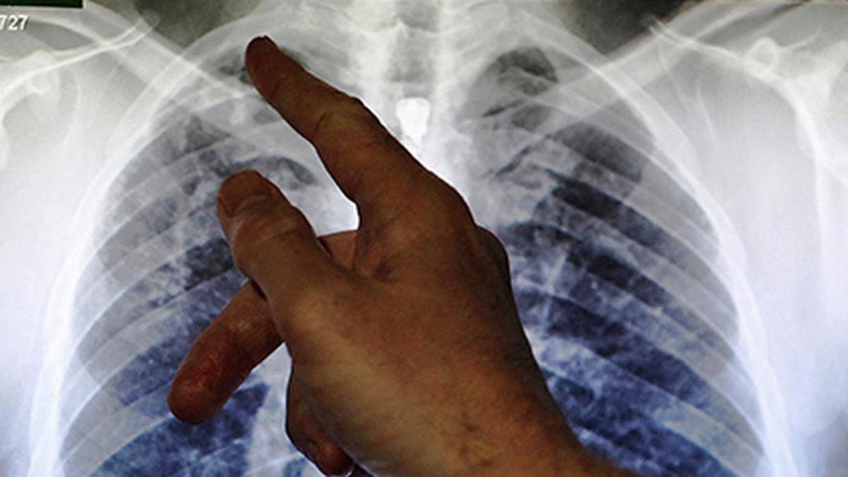 Indigenous Handheld X-ray for TB Screening: A Breakthrough for Public Health