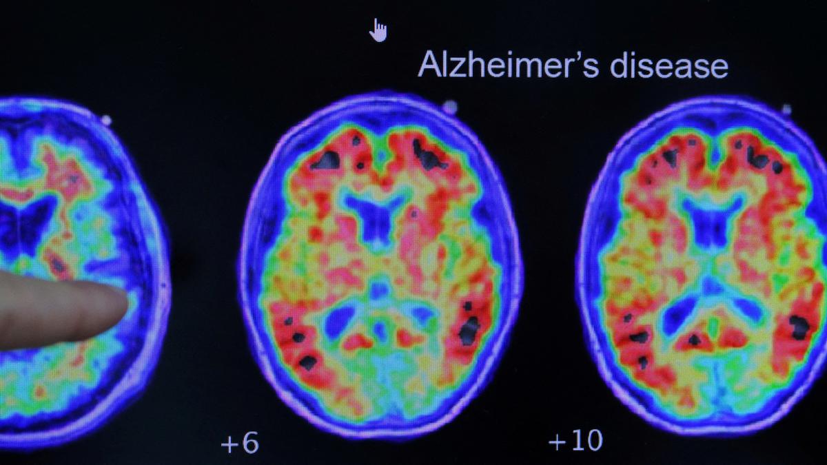 The curious link between Alzheimer’s disease and trauma