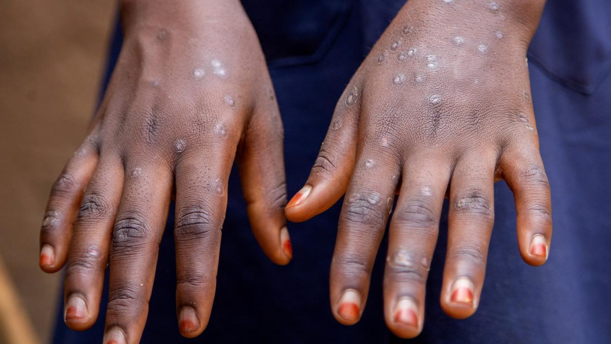 WHO urges rapid access to mpox diagnostic tests