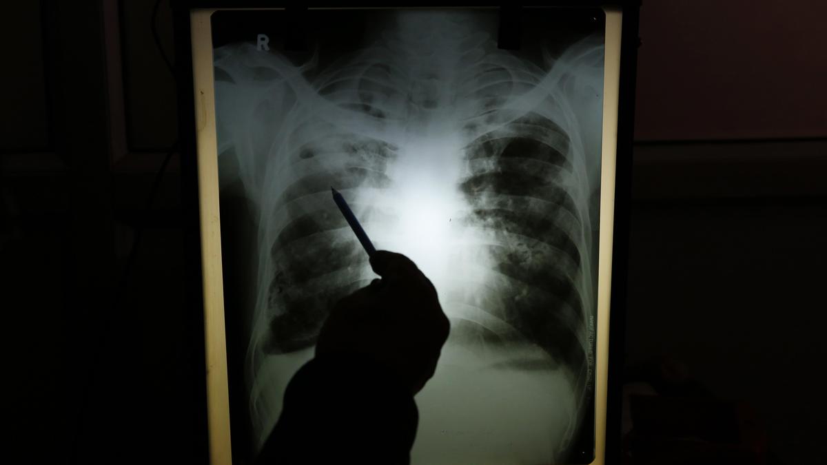 Drug-resistant TB poses a health emergency in India