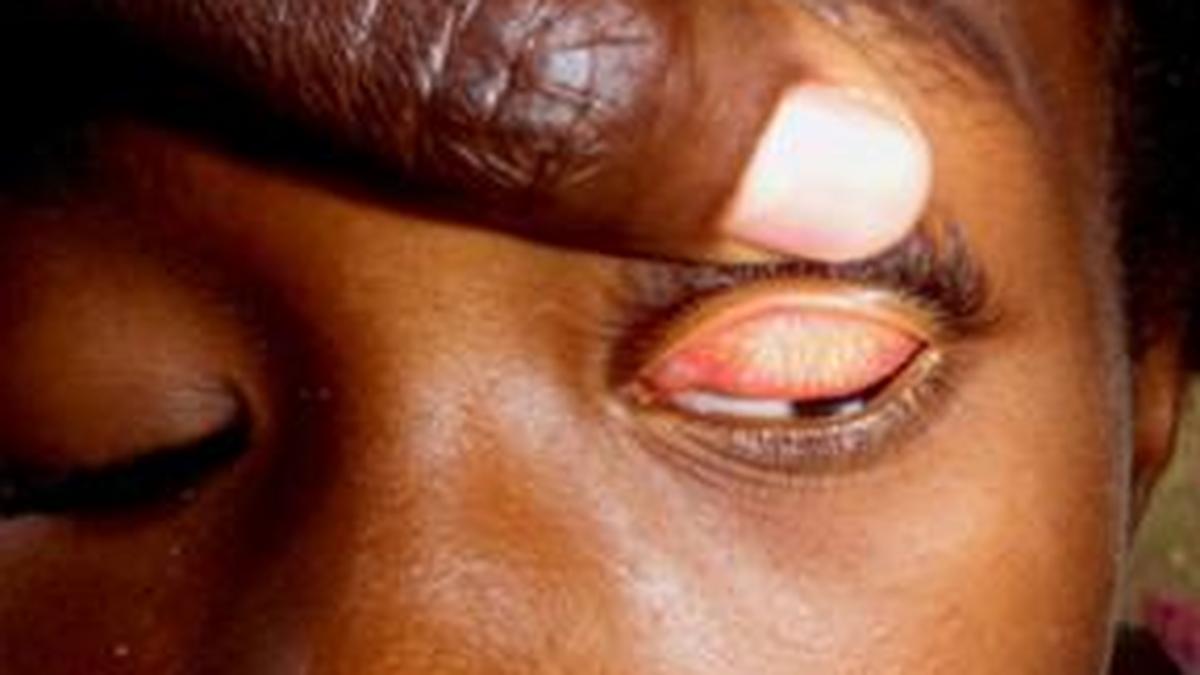 India has successfully eliminated trachoma as a public health problem: Explained
Premium