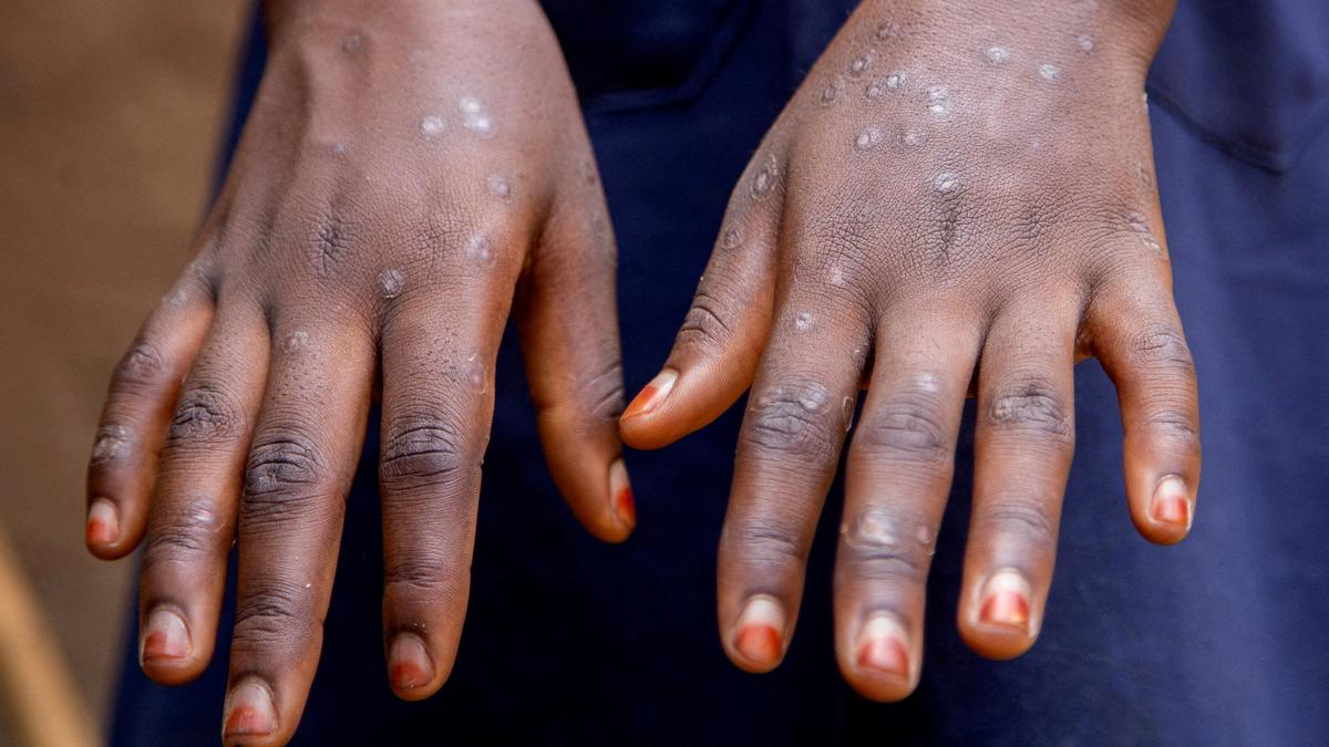 Should mpox be labelled a sexually transmitted disease?