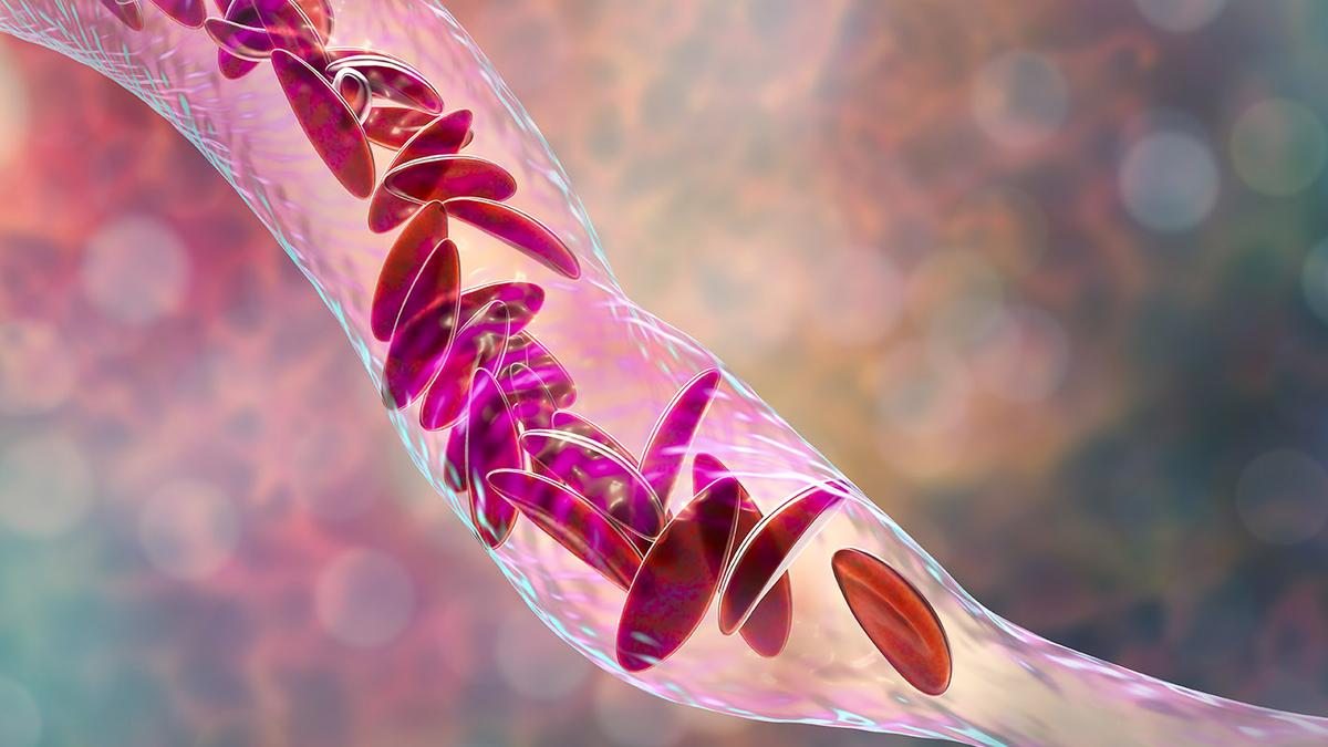 Six crore people screened for sickle cell disease: Health Ministry​