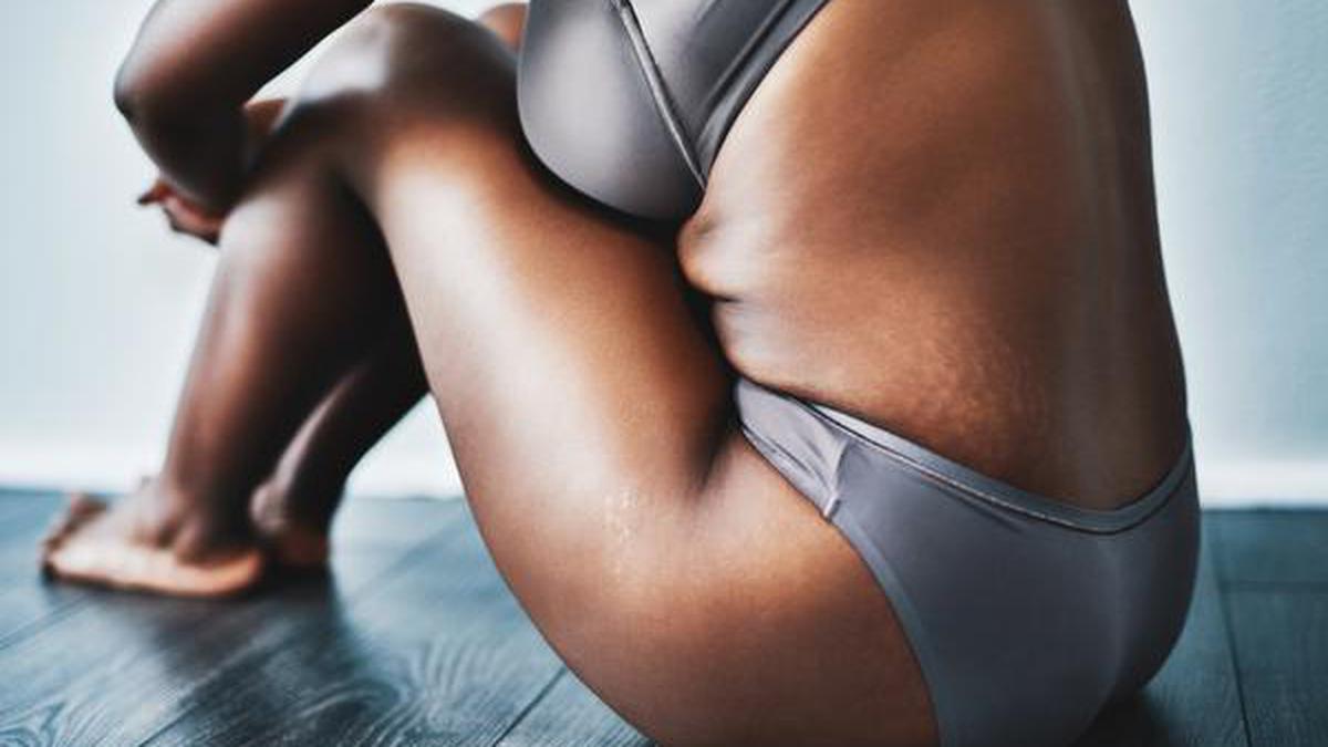 Stretch marks are now well-earned stripes for many on social media