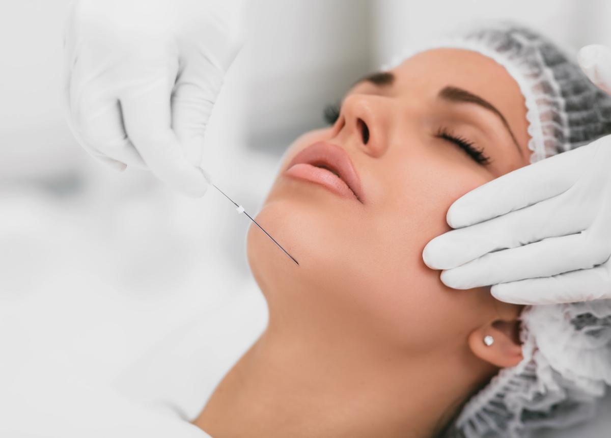 Mesothreads lifting and face contouring Mesothreads lifting and face contouring