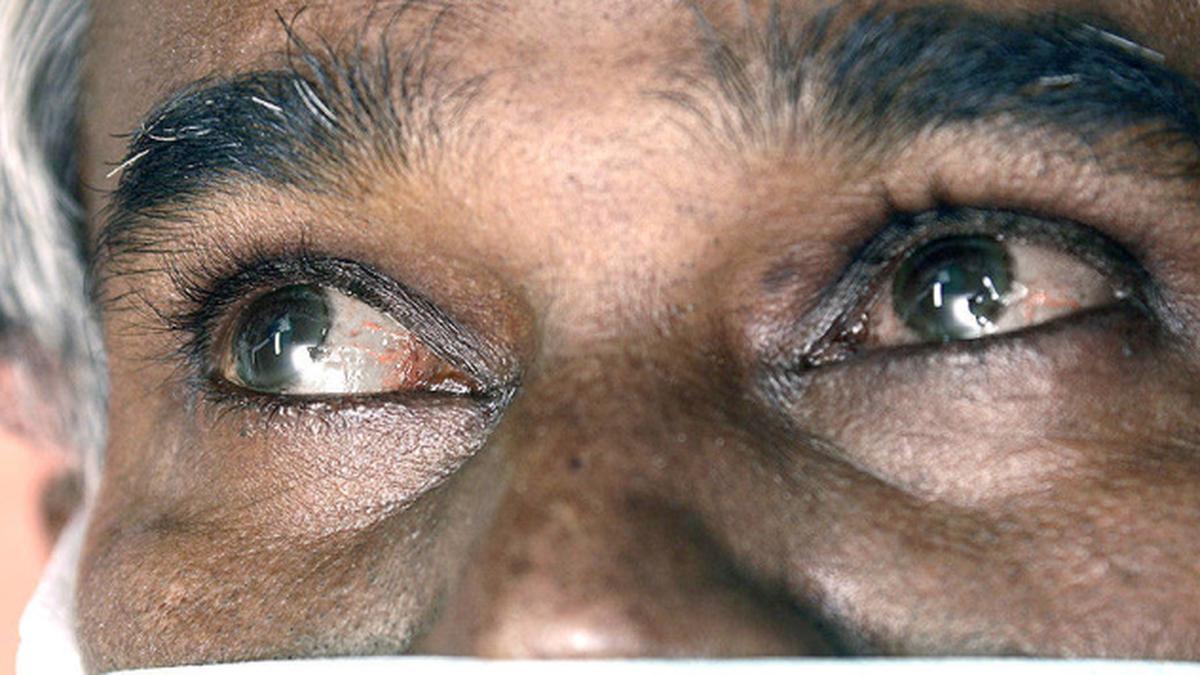 Why does a jaundiced person's eyes and skin look yellow? The Hindu