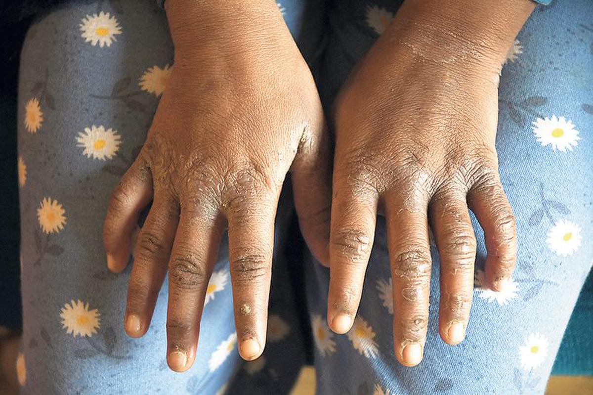 The girl shows her hands allegedly burnt by her employer and two adult sons in Gurugram’s Sector 57.