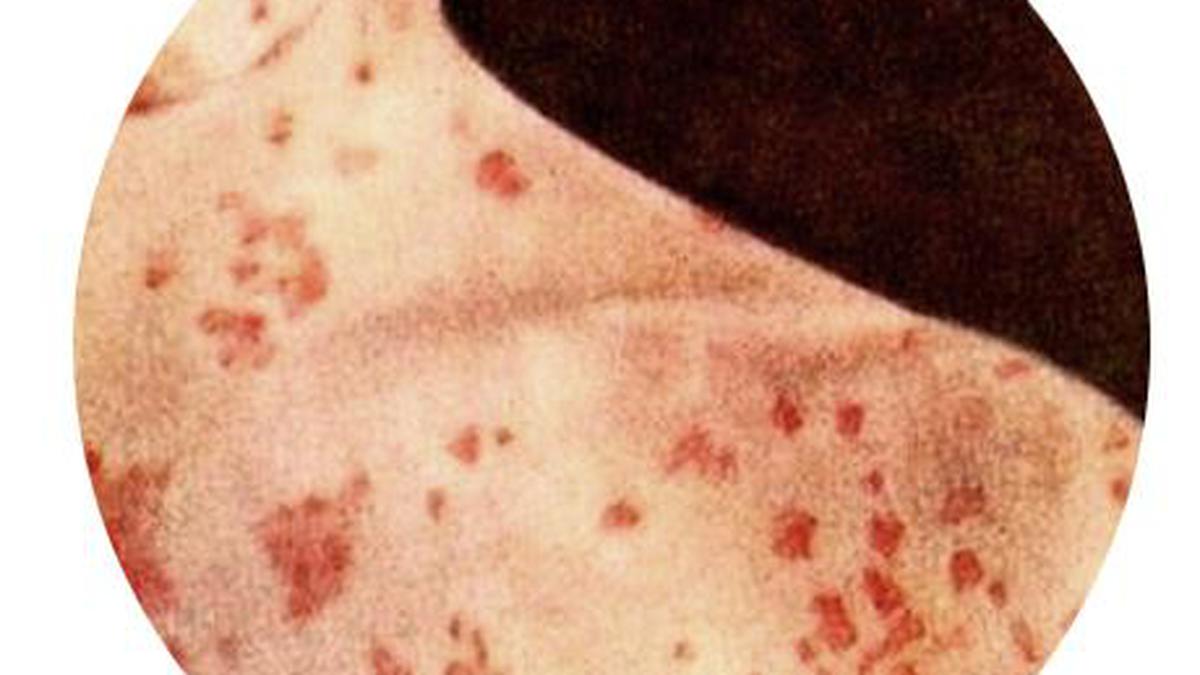 Measles: A children’s disease now affecting adults