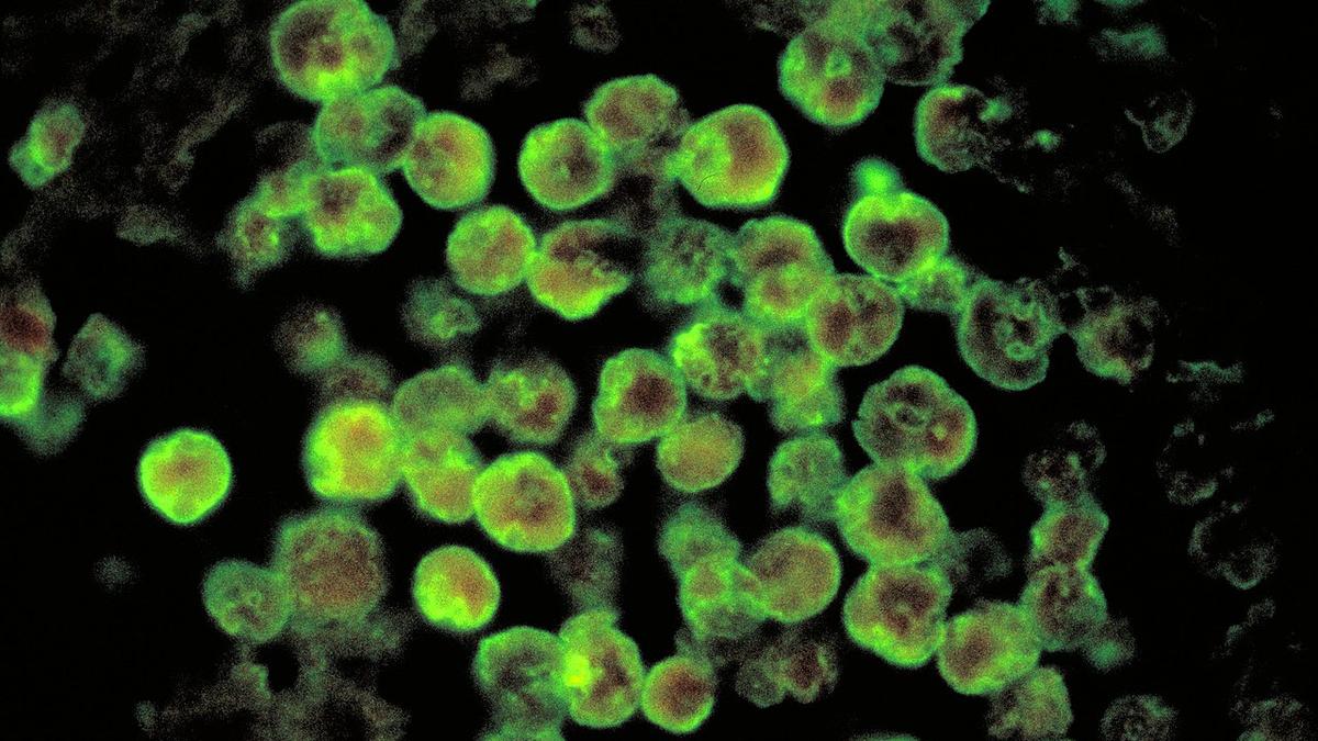 Amoebic meningoencephalitis claims two more lives