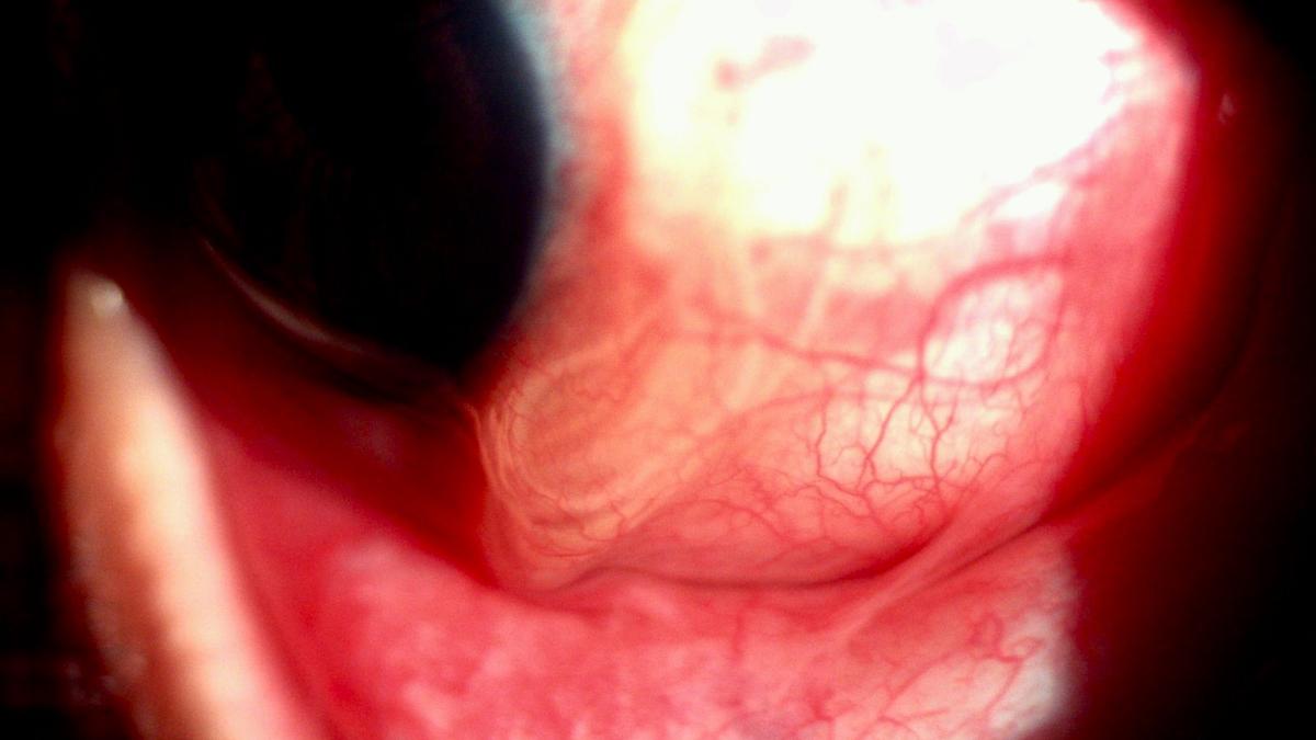 9.5cmlong roundworm pulled out from patient’s eye The Hindu