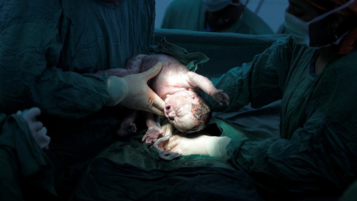Telangana records highest C-section rate in India; nearly 6 in 10 babies delivered through surgery