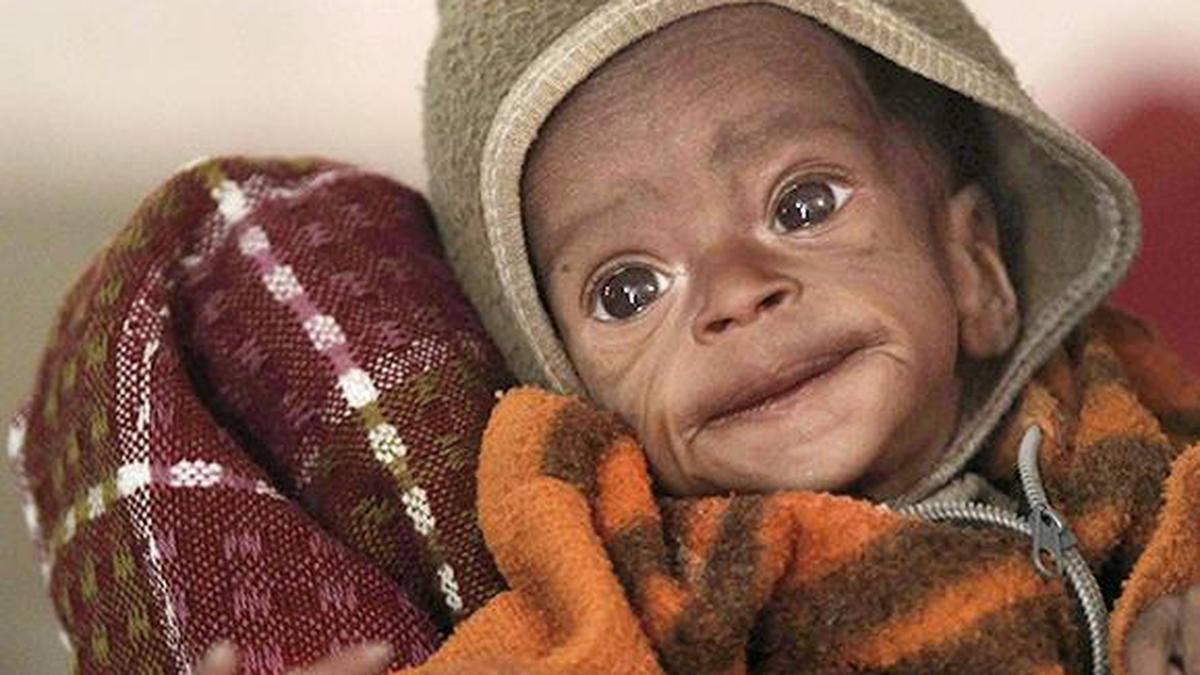 9.27 lakh severely acute malnourished children identified till November last year: RTI