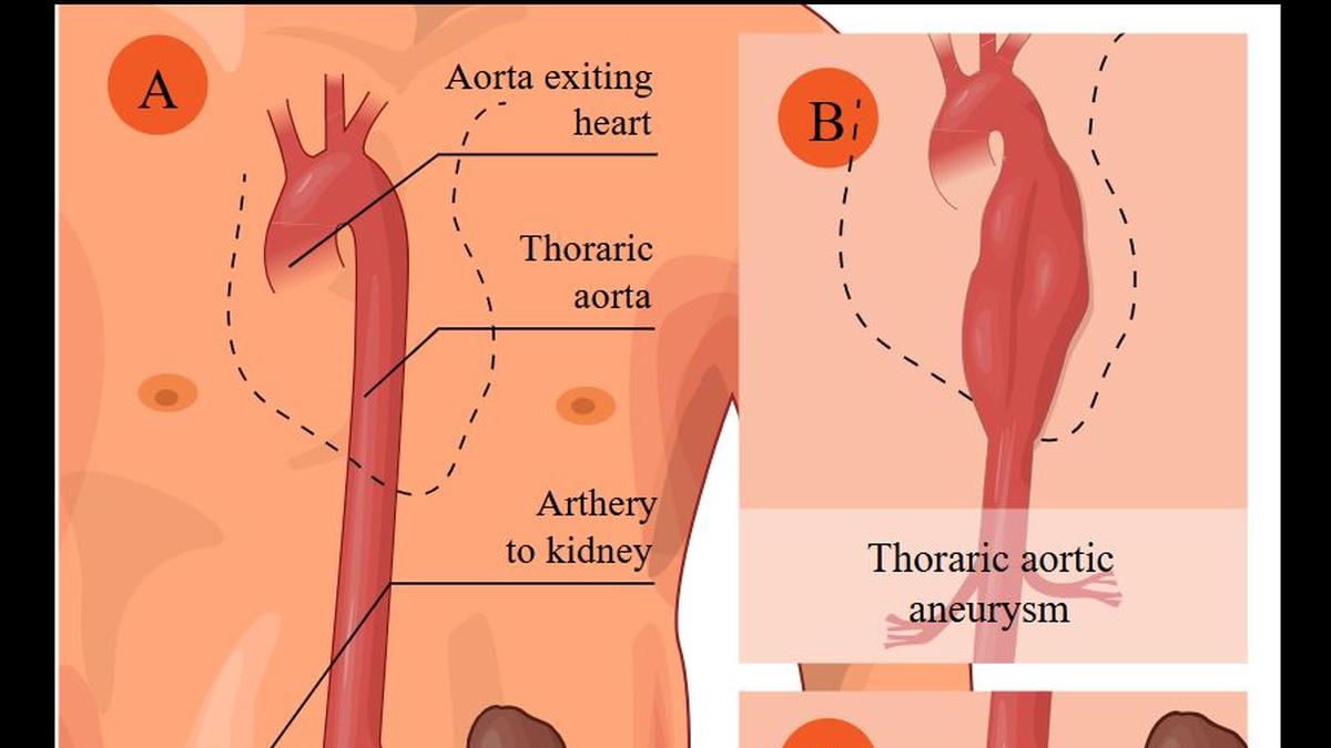 All you need to know about: aneurysms