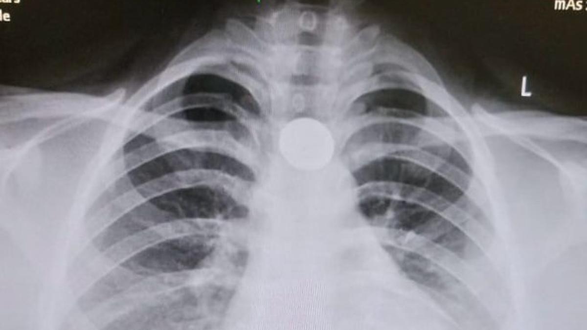 Coins, chemicals and more: doctors urge vigilance amid rise in accidental ingestions among kids during summer vacations
Premium