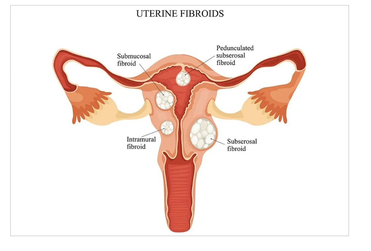 Uterine fibroids, also known as leiomyomas or myomas, are noncancerous (benign) tumors that develop in the uterus. They are the most common type of growth found in a woman’s pelvis and are typically not cancerous. These tumors can vary in size, from as small as an apple seed to as large as a grapefruit, and can grow in different locations within or on the uterus 