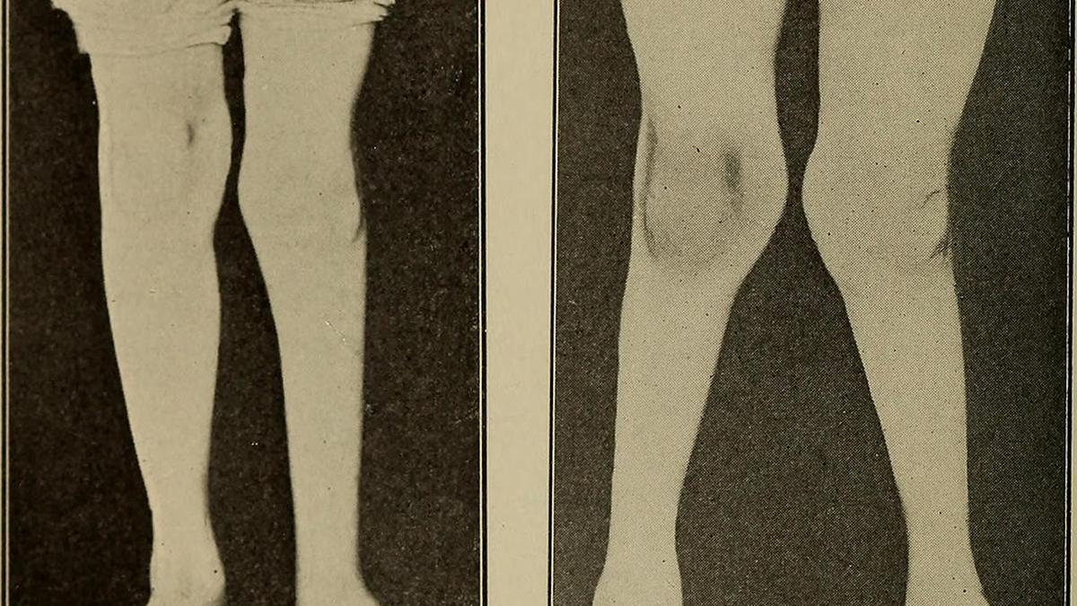 Growth modulation helps correct bone deformities in children with minimally invasive methods.