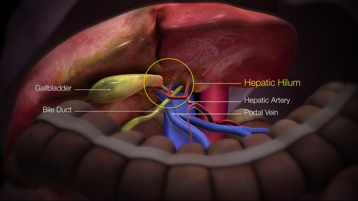 The risks of undiagnosed gall bladder stones: doctors call for awareness, timely treatment The risks of undiagnosed gall bladder stones: doctors call for awareness, timely treatment
