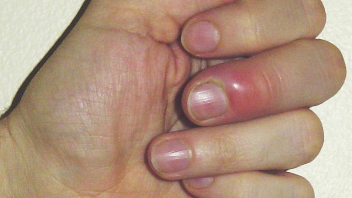 Not ‘only’ a nail infection