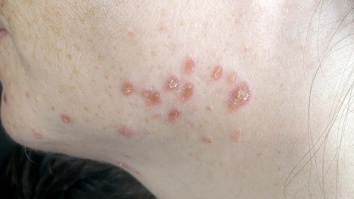 All you need to know about: sarcoidosis​