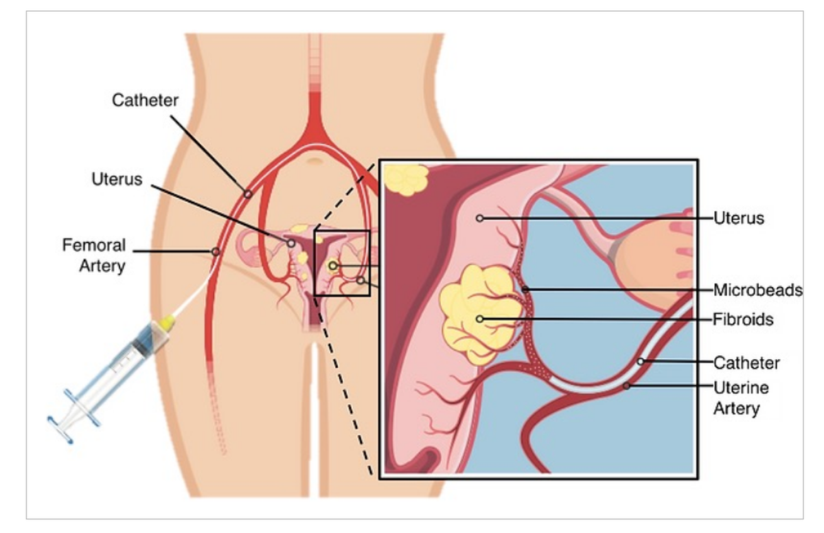 Os tratamentos fibrosos uterinos variam de acordo com a gravidade dos sintomas e das necessidades individuais do paciente. A espera térmica pode estar com ou sem condições leves para situações leves. Medicamentos como tratamentos hormonais (pílulas anticoncepcionais, pistas de GnRH) e analgésicos podem ajudar a gerenciar os sintomas. Opções cirúrgicas, como remoção de mordidas (remoção de fibróides) ou histerectomia (remoção uterina), estão disponíveis para fibróides ou sintomas maiores. Além disso, os procedimentos invasivos fornecem mínimo, como a obstrução da artéria uterina e a ressonância magnética, ultrassom Os tratamentos fibrosos uterinos variam de acordo com a gravidade dos sintomas e das necessidades individuais do paciente. A espera térmica pode estar com ou sem condições leves para situações leves. Medicamentos como tratamentos hormonais (pílulas anticoncepcionais, pistas de GnRH) e analgésicos podem ajudar a gerenciar os sintomas. Opções cirúrgicas, como remoção de mordidas (remoção de fibróides) ou histerectomia (remoção uterina), estão disponíveis para fibróides ou sintomas maiores. Além disso, os procedimentos invasivos fornecem mínimo, como a obstrução da artéria uterina e a ressonância magnética, ultrassom