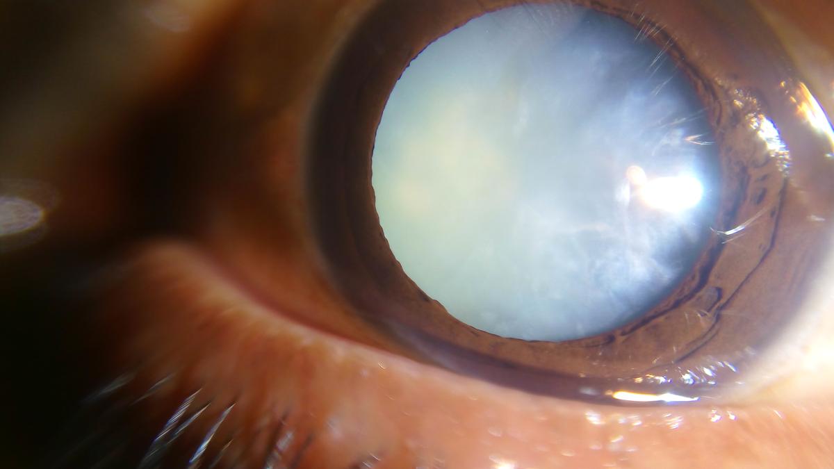 Understanding cataracts and the surgery to treat them Understanding cataracts and the surgery to treat them