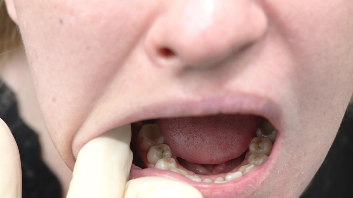 The role Fusobacterium plays in oral cancer patients in India