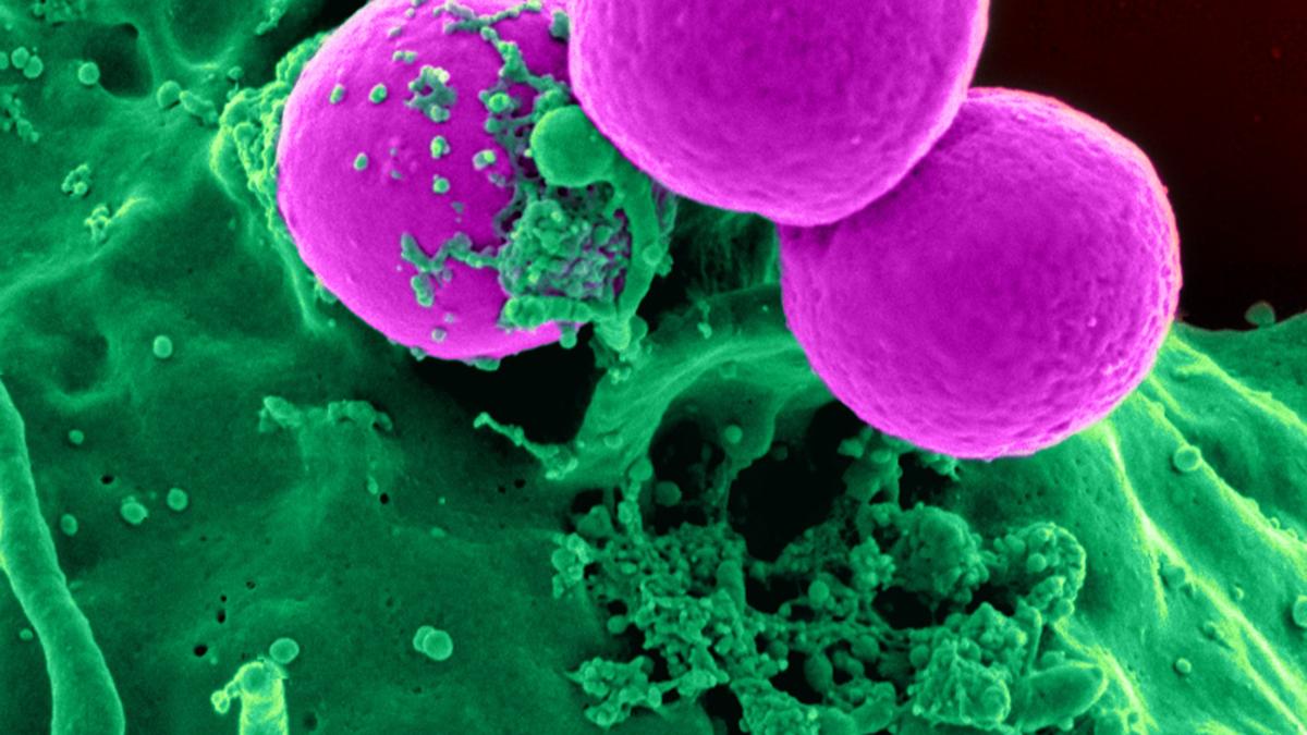 Vancomycin may not be able to treat MRSA infections for long
Premium