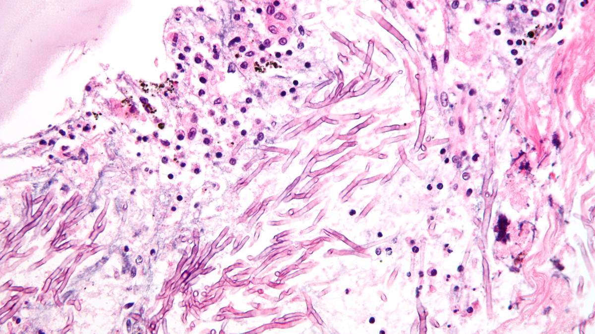 India still short on expertise, tools to manage fungal health burden