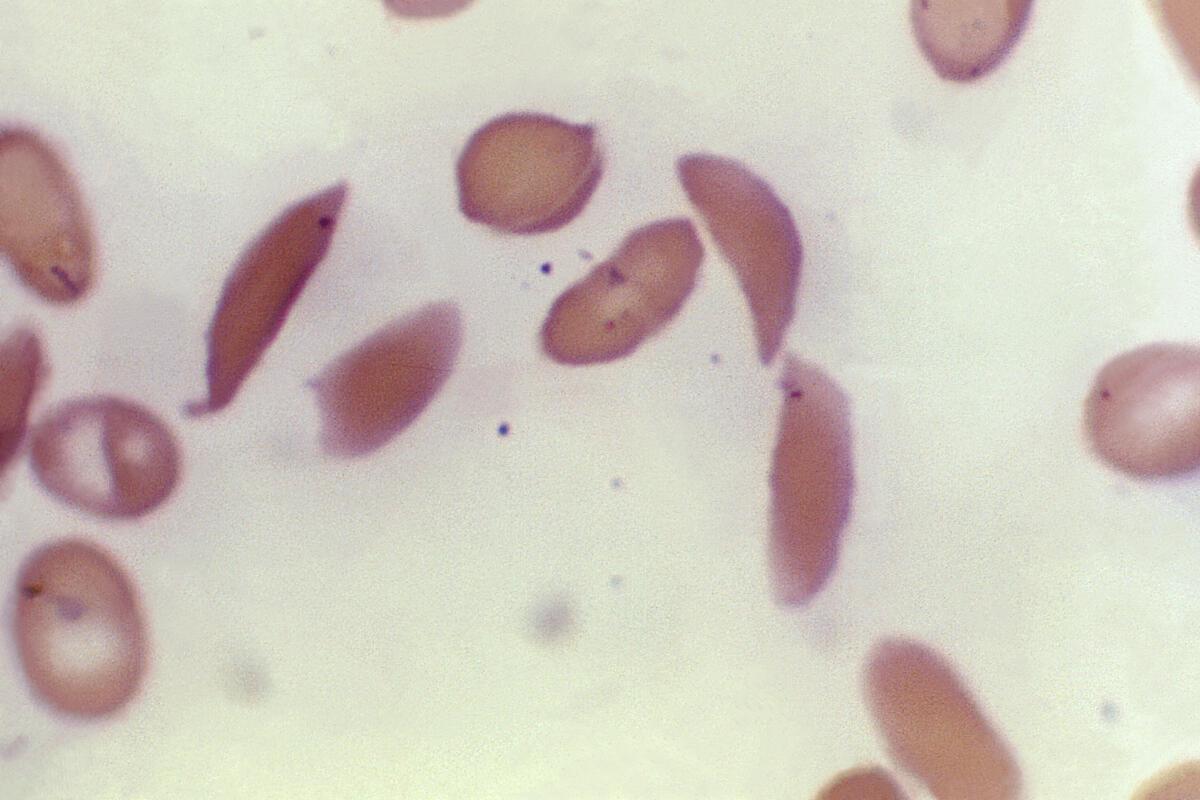 This microscope photo shows crescent-shaped red blood cells from a sickle cell disease patient in 1972. The disorder affects haemoglobin, the protein in red blood cells that carries oxygen. A genetic mutation causes the cells to become crescent-shaped, which can block blood flow and cause excruciating pain, organ damage, stroke, and other problems.
