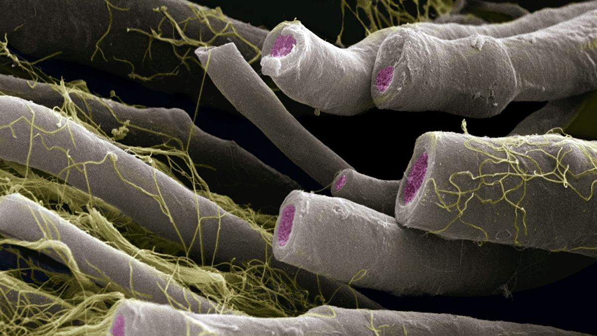 Out-of-balance bacteria is linked to multiple sclerosis, can predict severity: new research