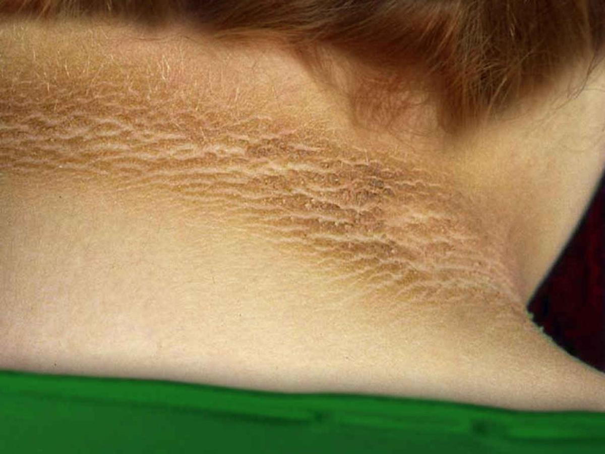 The thickened, darker, velvety skin shown here, known as acanthosis nigricans, is a potential warning sign of developing type 2 diabetes. The condition is likely to appear on the neck, elbows, knees and other areas where the skin folds.