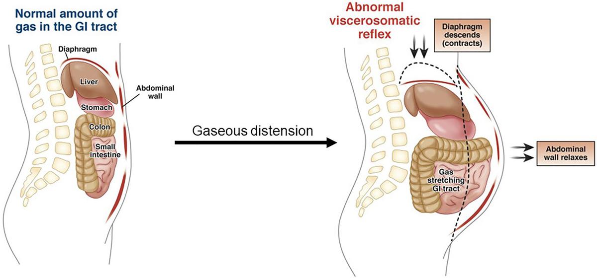 Normally, when the intestines fill with gas, the diaphragm relaxes and the anterior abdominal wall contracts to bolster the abdominal cavity. By contrast, abdominal distension results when the diaphragm contracts, the viscera fall with gravity, and the anterior abdominal wall relaxes, leading to outpouching in the upright position.