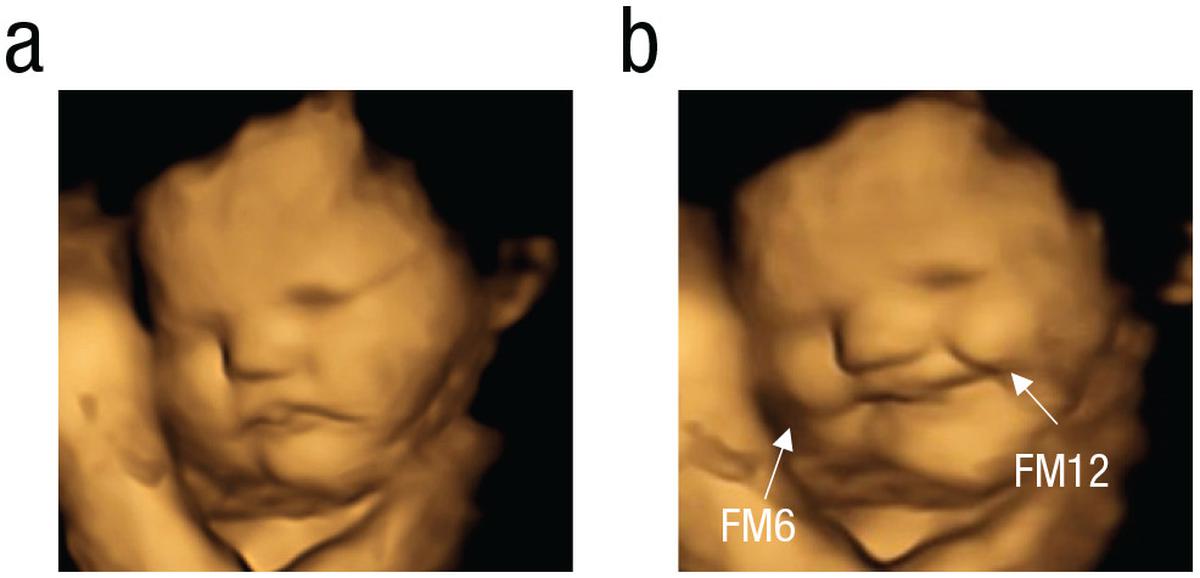 Ultrasound scan of laughter-face gestalt of a carrot-exposed foetus.