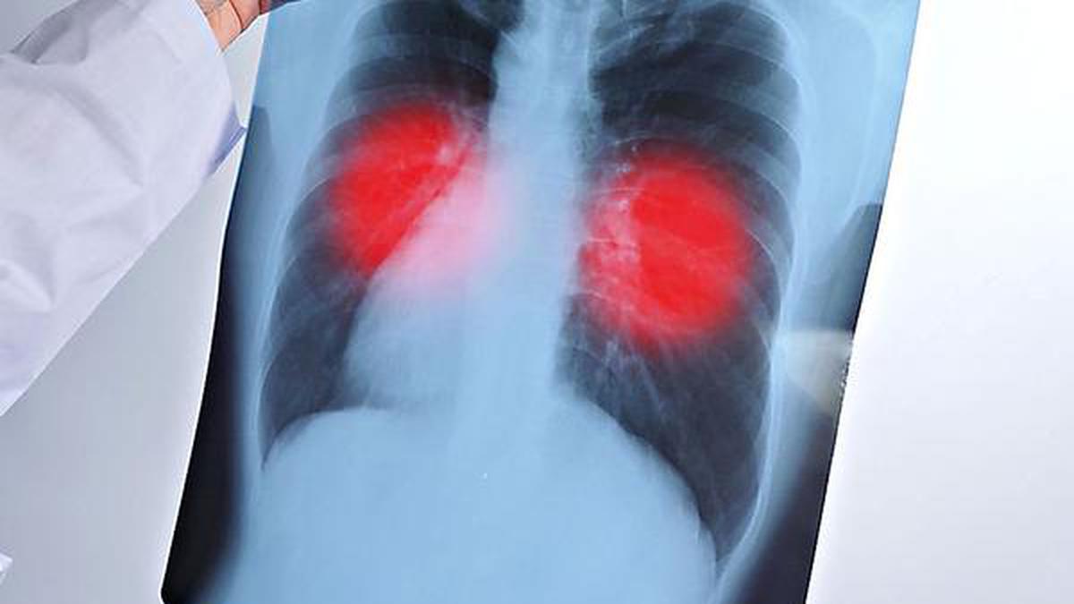 Les médecins s’inquiètent de l’omission de la pneumologie selon les nouvelles normes du NMC